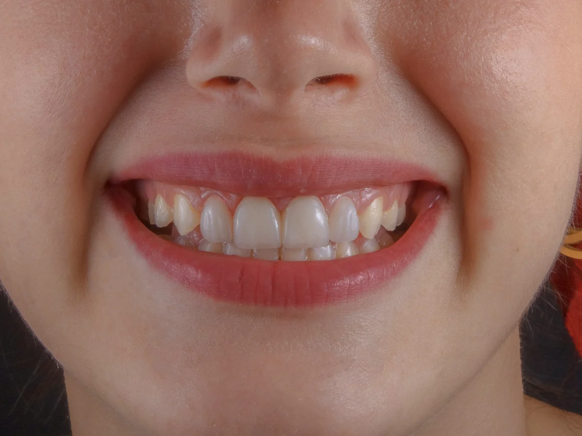 The same teeth after whitening.