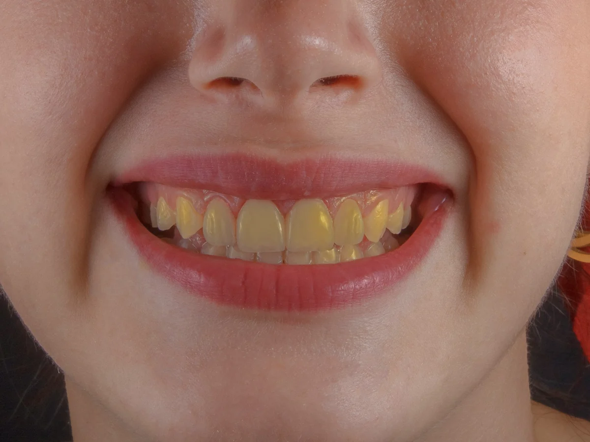 Teeth before whitening, noticeably yellowed.